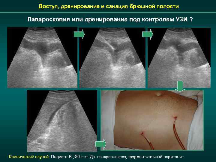 Доступ, дренирование и санация брюшной полости Лапароскопия или дренирование под контролем УЗИ ? Клинический