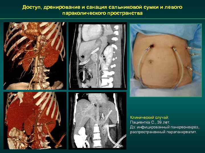 Доступ, дренирование и санация сальниковой сумки и левого параколического пространства Клинический случай: Пациентка С.