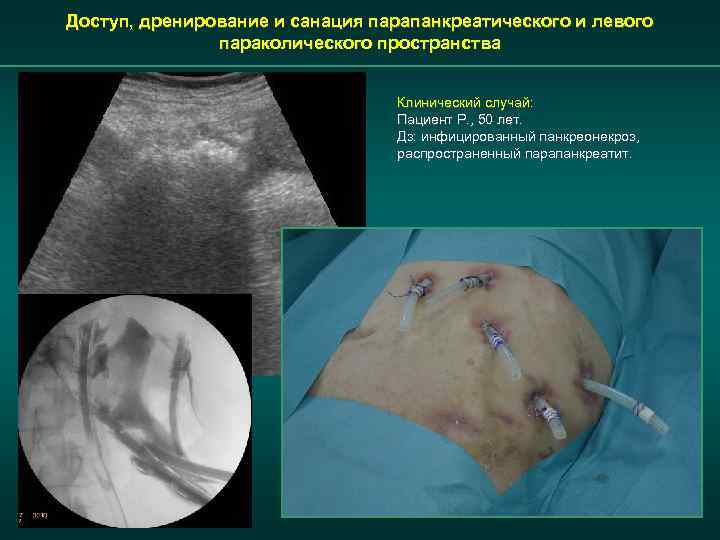 Доступ, дренирование и санация парапанкреатического и левого параколического пространства Клинический случай: Пациент Р. ,