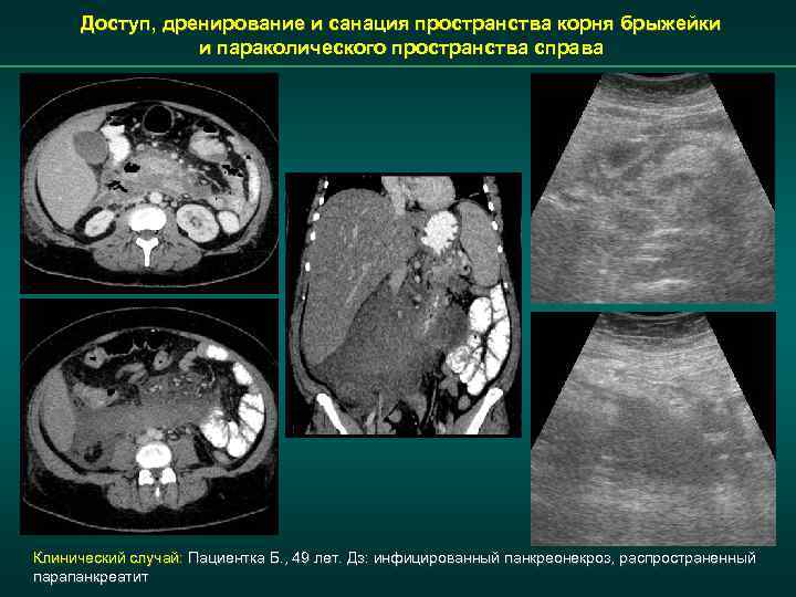 Доступ, дренирование и санация пространства корня брыжейки и параколического пространства справа Клинический случай: Пациентка