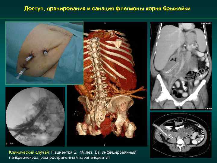 Доступ, дренирование и санация флегмоны корня брыжейки Клинический случай: Пациентка Б. , 49 лет.