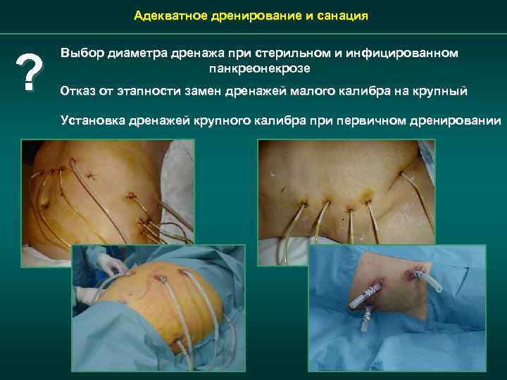 Адекватное дренирование и санация ? Выбор диаметра дренажа при стерильном и инфицированном панкреонекрозе Отказ