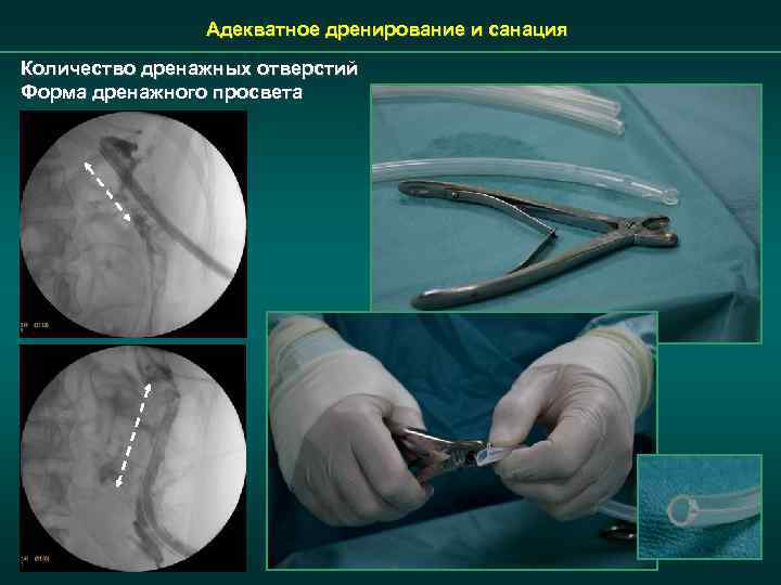 Адекватное дренирование и санация Количество дренажных отверстий Форма дренажного просвета 