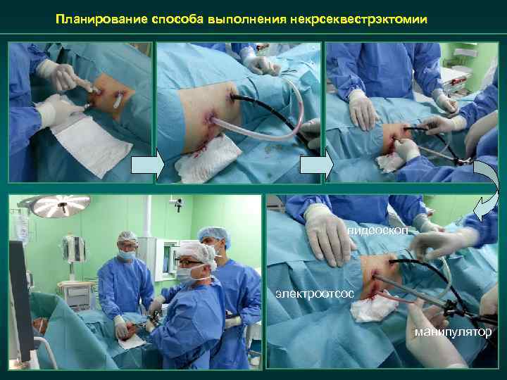 Планирование способа выполнения некрсеквестрэктомии видеоскоп электроотсос манипулятор 