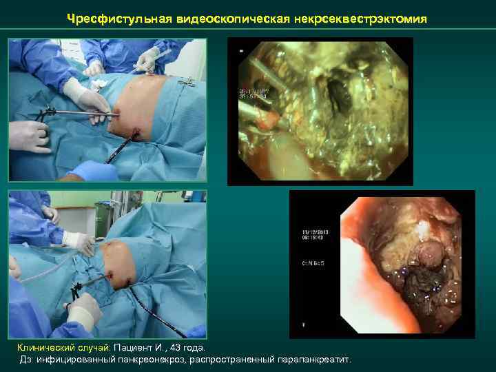 Чресфистульная видеоскопическая некрсеквестрэктомия Клинический случай: Пациент И. , 43 года. Дз: инфицированный панкреонекроз, распространенный