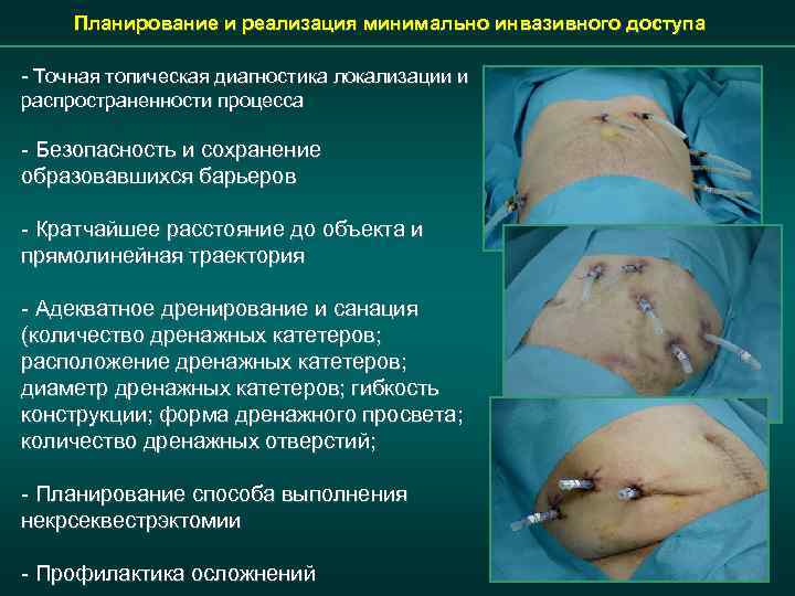 Планирование и реализация минимально инвазивного доступа - Точная топическая диагностика локализации и распространенности процесса