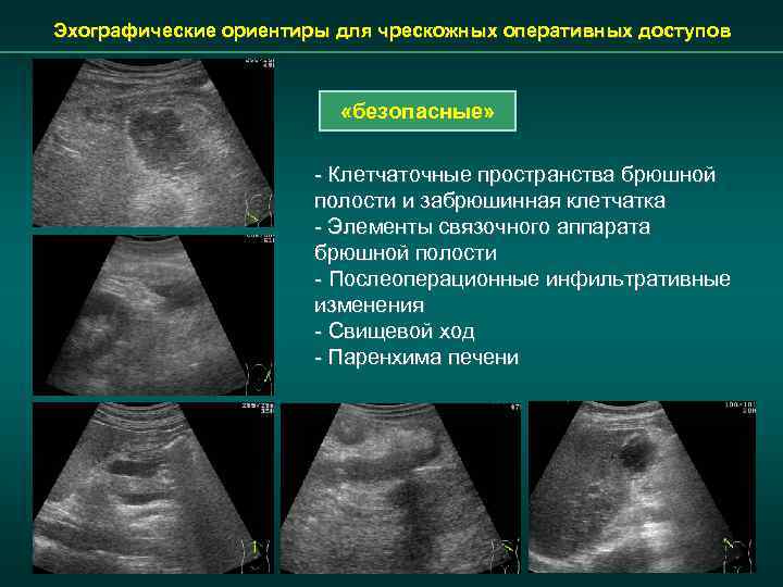 Эхографические ориентиры для чрескожных оперативных доступов «безопасные» - Клетчаточные пространства брюшной полости и забрюшинная