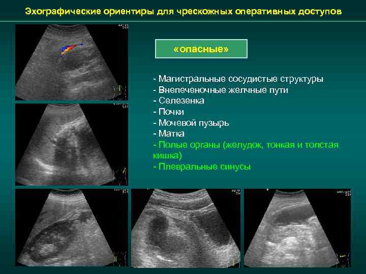 Эхографические ориентиры для чрескожных оперативных доступов «опасные» - Магистральные сосудистые структуры - Внепеченочные желчные