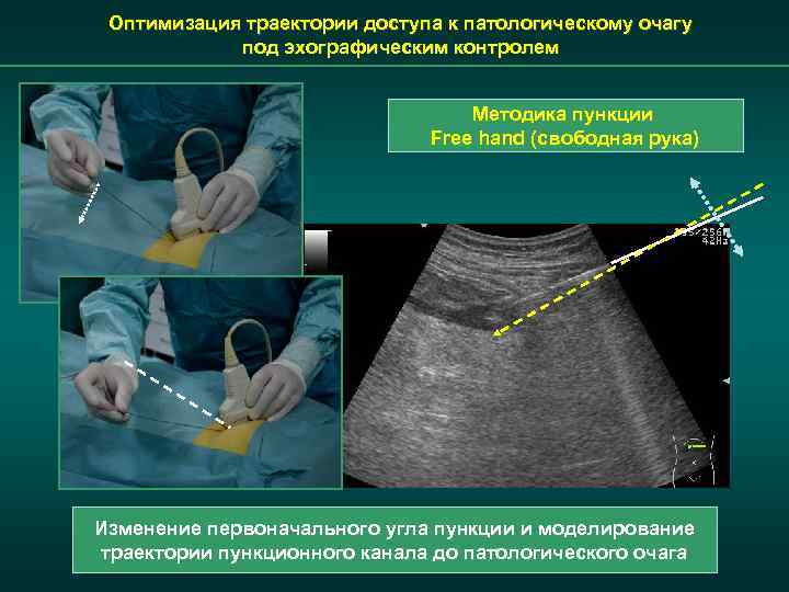 Оптимизация траектории доступа к патологическому очагу под эхографическим контролем Методика пункции Free hand (свободная