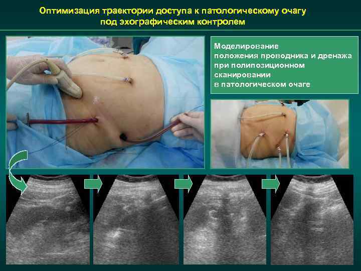 Оптимизация траектории доступа к патологическому очагу под эхографическим контролем Моделирование положения проводника и дренажа