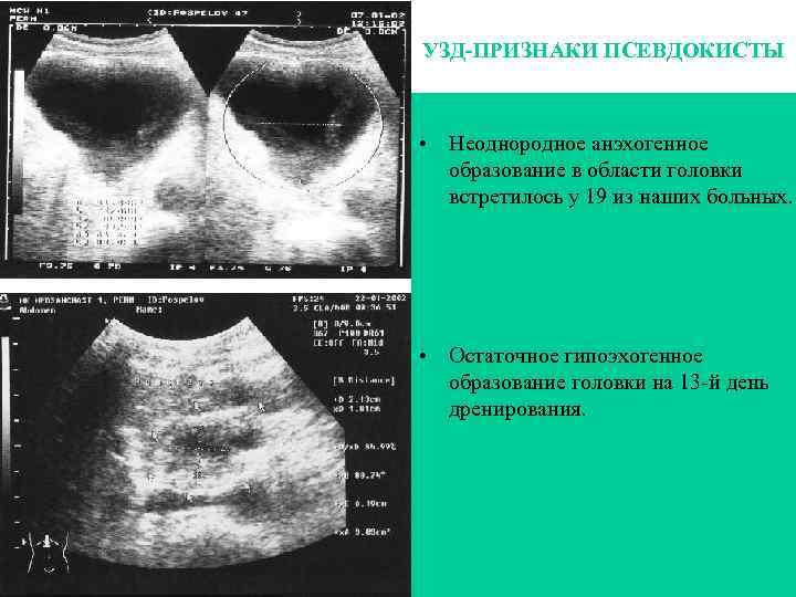 Расширенная полость матки с анэхогенным содержимым