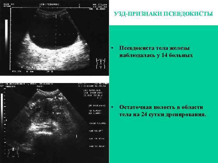 УЗД-ПРИЗНАКИ ПСЕВДОКИСТЫ • Псевдокиста тела железы наблюдалась у 14 больных • Остаточная полость в