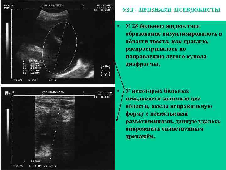 Визуализируется. Жидкостное образование УЗИ. Жидкостное образование в области придатков. Жидкостное образование левого придатка. Жидкостное образование в яичнике.