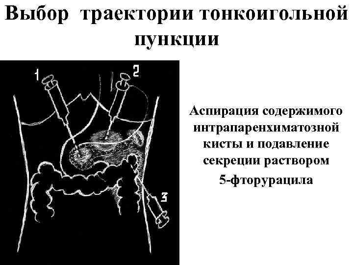 Выбор траектории тонкоигольной пункции Аспирация содержимого интрапаренхиматозной кисты и подавление секреции раствором 5 -фторурацила