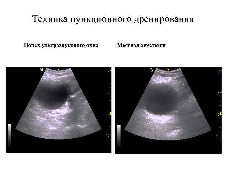 Техника пункционного дренирования Поиск ультразвукового окна Местная анестезия 