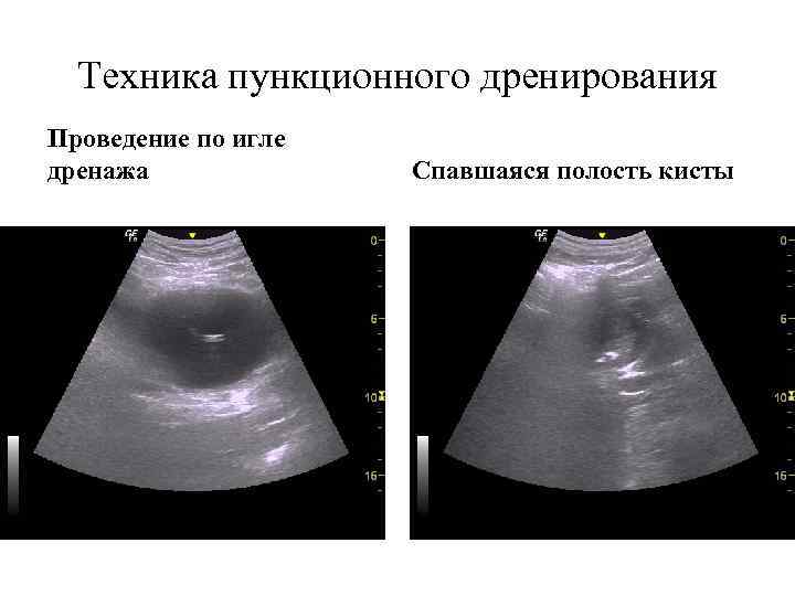 Техника пункционного дренирования Проведение по игле дренажа Спавшаяся полость кисты 