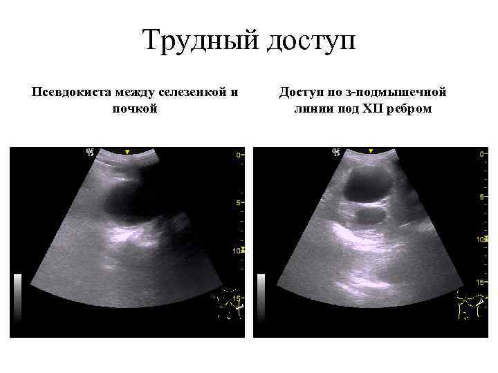 Трудный доступ Псевдокиста между селезенкой и почкой Доступ по з-подмышечной линии под XII ребром