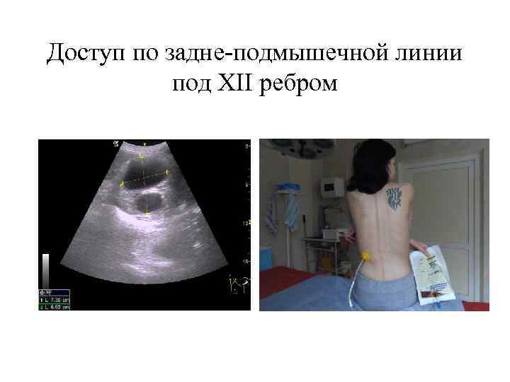Доступ по задне-подмышечной линии под XII ребром 