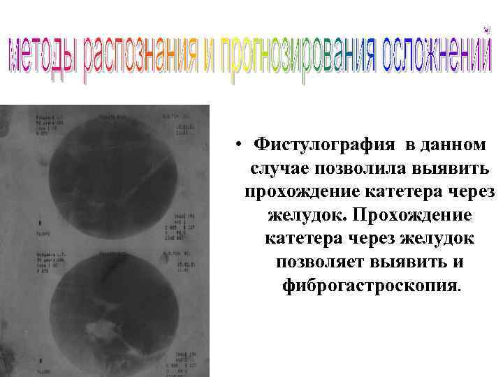  • Фистулография в данном случае позволила выявить прохождение катетера через желудок. Прохождение катетера