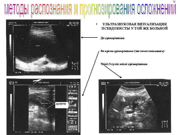  • УЛЬТРАЗВУКОВАЯ ВИЗУАЛИЗАЦИЯ ПСЕВДОКИСТЫ У ТОЙ ЖЕ БОЛЬНОЙ • До дренирования • Во