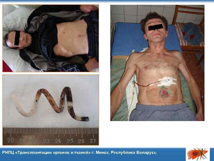 РНПЦ «Трансплантации органов и тканей» г. Минск, Республика Беларусь 