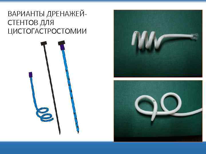 ВАРИАНТЫ ДРЕНАЖЕЙСТЕНТОВ ДЛЯ ЦИСТОГАСТРОСТОМИИ 