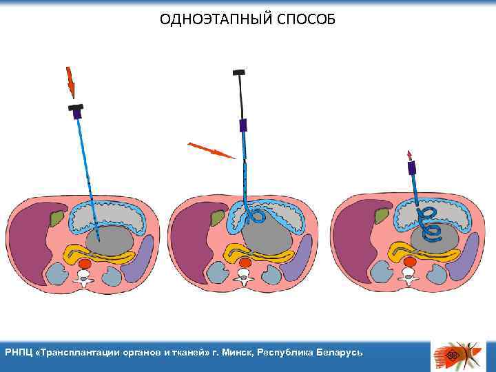 ОДНОЭТАПНЫЙ СПОСОБ РНПЦ «Трансплантации органов и тканей» г. Минск, Республика Беларусь 