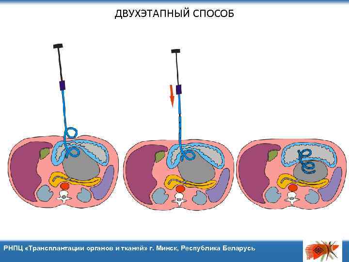 ДВУХЭТАПНЫЙ СПОСОБ РНПЦ «Трансплантации органов и тканей» г. Минск, Республика Беларусь 