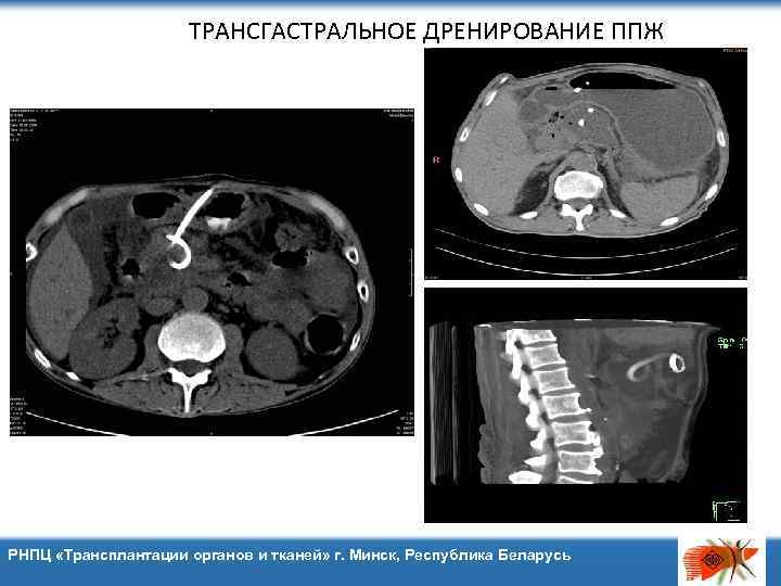 ТРАНСГАСТРАЛЬНОЕ ДРЕНИРОВАНИЕ ППЖ РНПЦ «Трансплантации органов и тканей» г. Минск, Республика Беларусь 