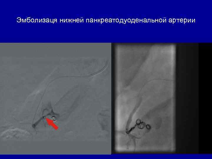 Эмболизаця нижней панкреатодуоденальной артерии 
