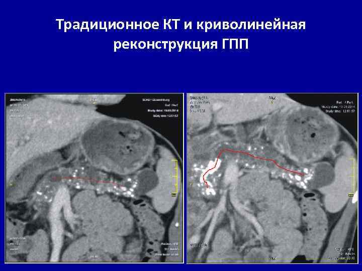 Традиционное КТ и криволинейная реконструкция ГПП 