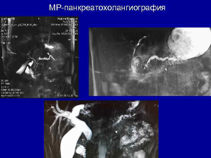 МР-панкреатохолангиография 