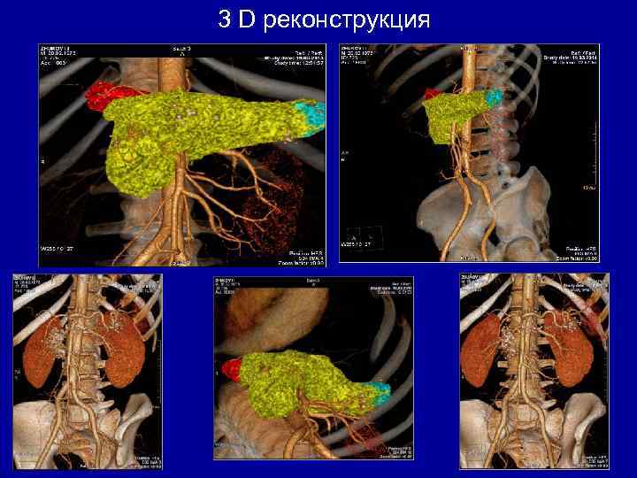 3 D реконструкция 