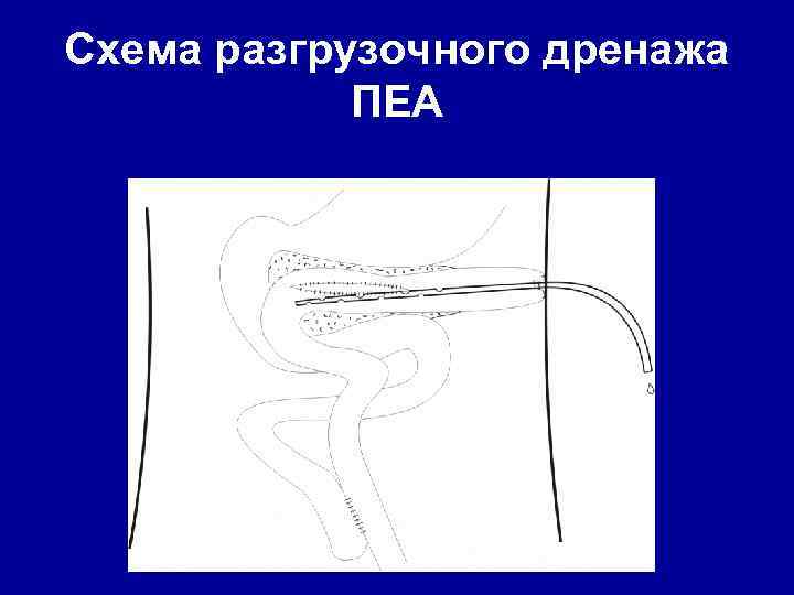 Схема разгрузочного дренажа ПЕА 