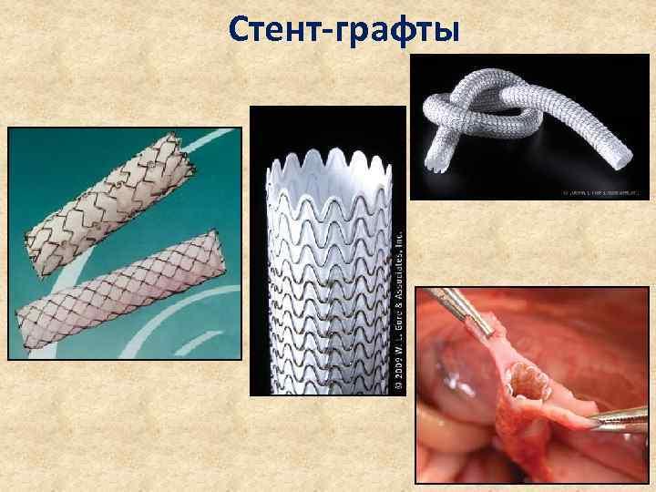 Стент-графты 