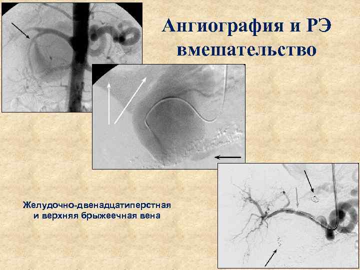 Ангиография и РЭ вмешательство Желудочно-двенадцатиперстная и верхняя брыжеечная вена 