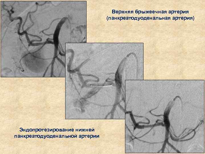 Верхняя брыжеечная артерия (панкреатодуоденальная артерия) Эндопротезирование нижней панкреатодуоденальной артерии 
