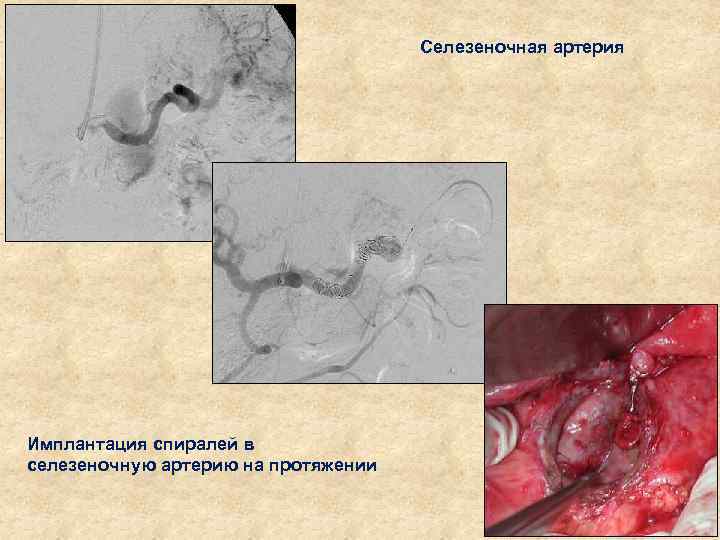 Селезеночная артерия Имплантация спиралей в селезеночную артерию на протяжении 