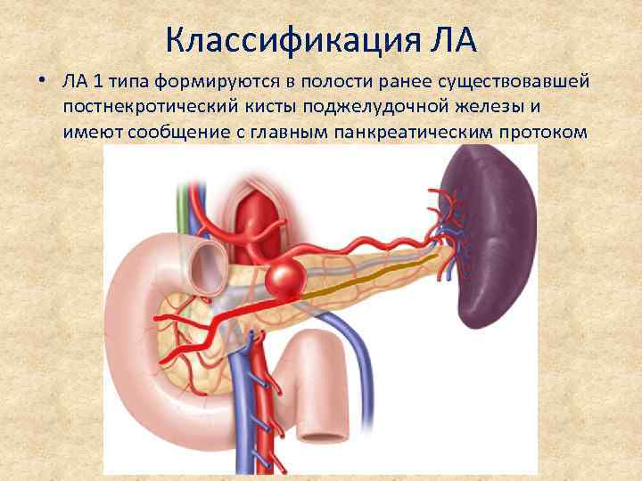 Классификация ЛА • ЛА 1 типа формируются в полости ранее существовавшей постнекротический кисты поджелудочной
