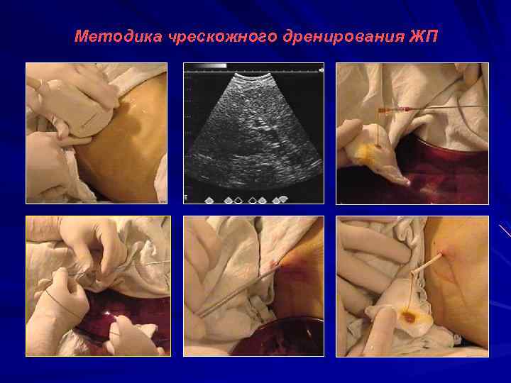 Методика чрескожного дренирования ЖП 