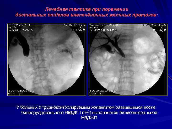 Лечебная тактика при поражении дистальных отделов внепечёночных желчных протоков: У больных с трудноконтролируемым холангитом