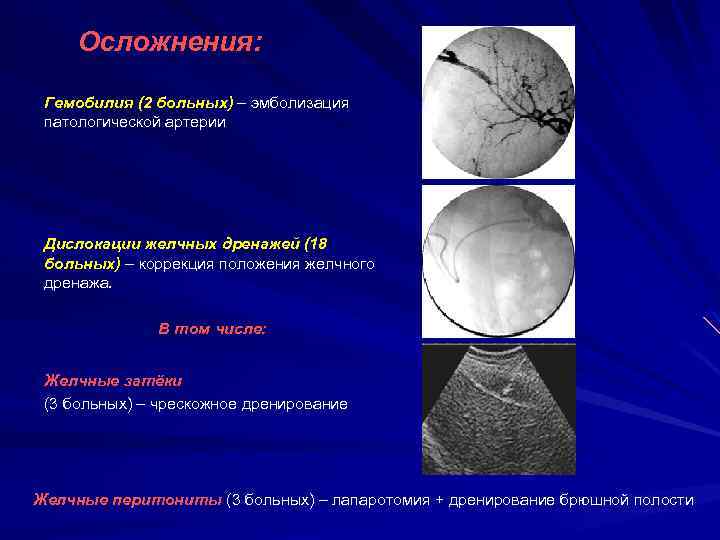 Осложнения: Гемобилия (2 больных) – эмболизация патологической артерии Дислокации желчных дренажей (13 (18 больных)