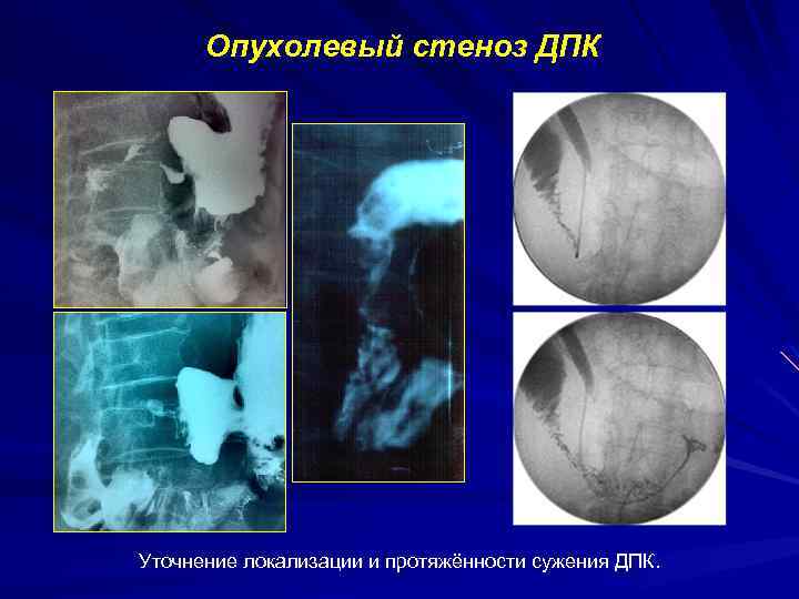 Опухолевый стеноз ДПК Уточнение локализации и протяжённости сужения ДПК. 