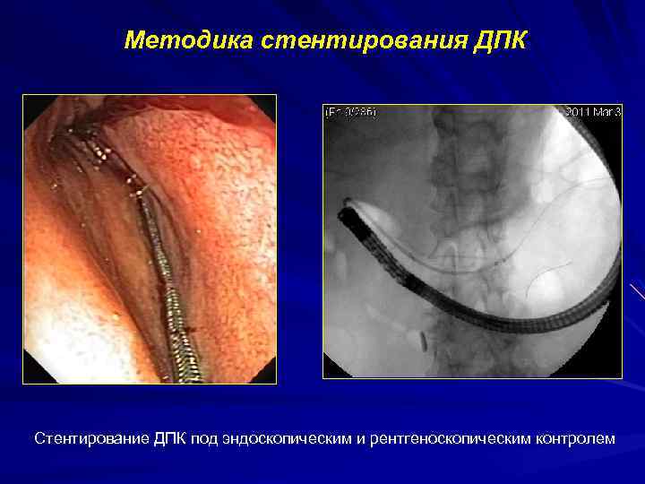 Методика стентирования ДПК Стентирование ДПК под эндоскопическим и рентгеноскопическим контролем 