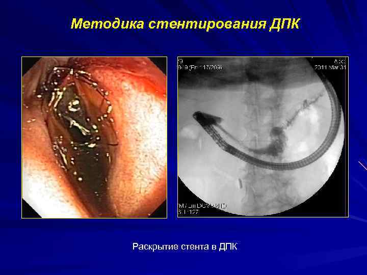 Методика стентирования ДПК Раскрытие стента в ДПК 