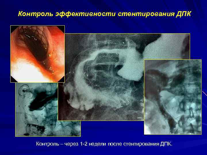 Контроль эффективности стентирования ДПК Контроль – через 1 -2 недели после стентирования ДПК. 