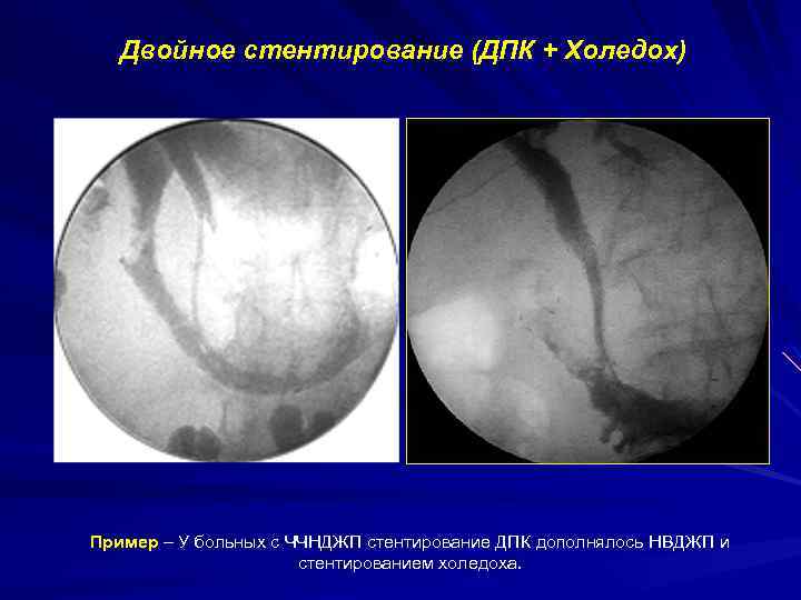 Двойное стентирование (ДПК + Холедох) Пример – У больных с ЧЧНДЖП стентирование ДПК дополнялось