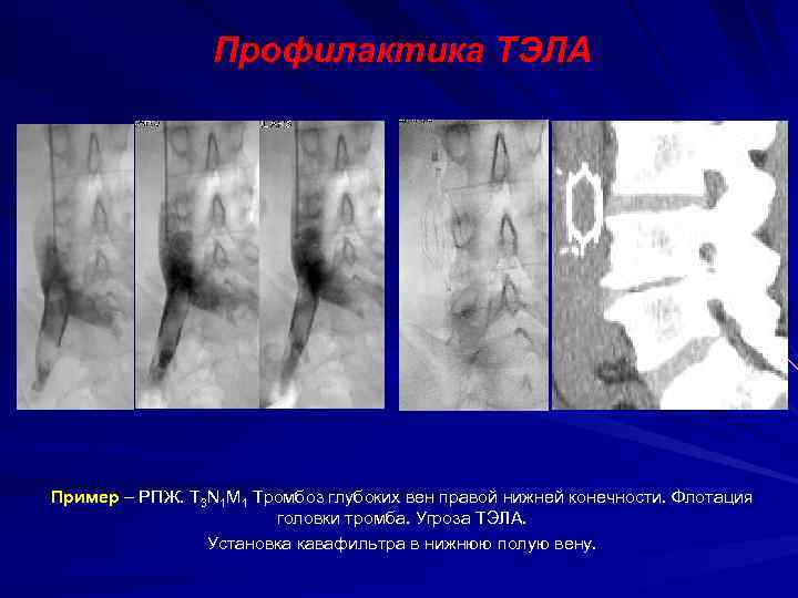 Профилактика ТЭЛА Пример – РПЖ. T 3 N 1 M 1 Тромбоз глубоких вен