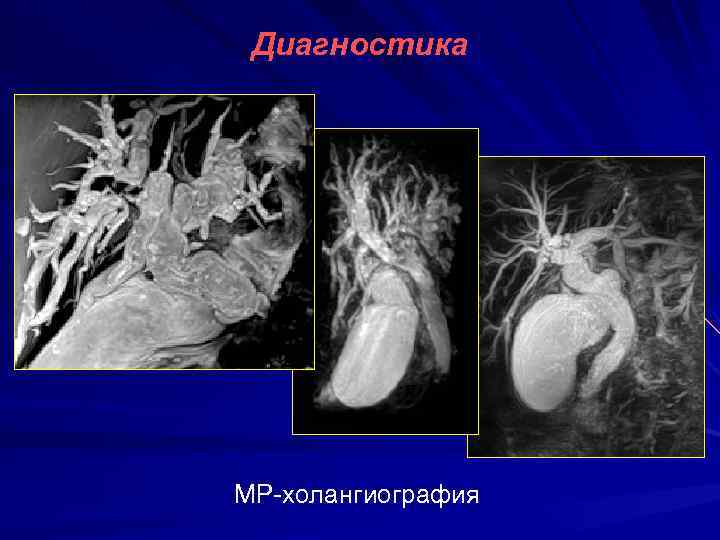 Диагностика МР-холангиография 