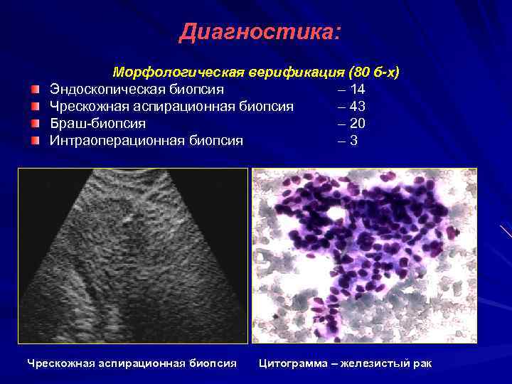 Диагностика: Морфологическая верификация (80 б-х) Эндоскопическая биопсия – 14 Чрескожная аспирационная биопсия – 43